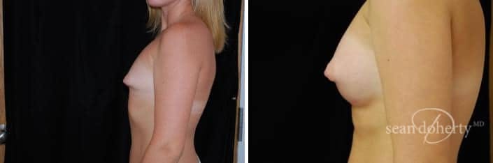 Breast Augmentation Before & After Gallery - Patient 309403 - Image 3
