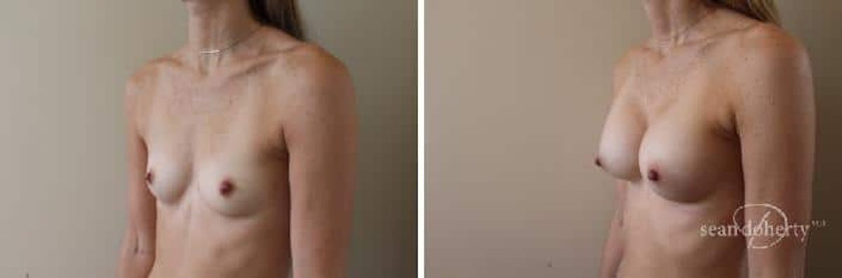 Breast Augmentation  Before & After Gallery - Patient 392805 - Image 4