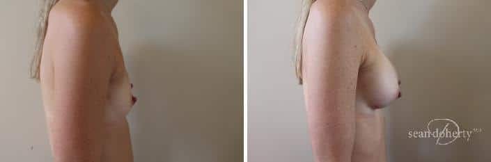 Breast Augmentation Before & After Gallery - Patient 392805 - Image 3