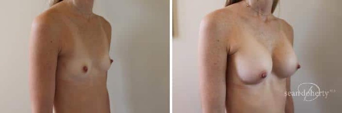Breast Augmentation  Before & After Gallery - Patient 392805 - Image 2