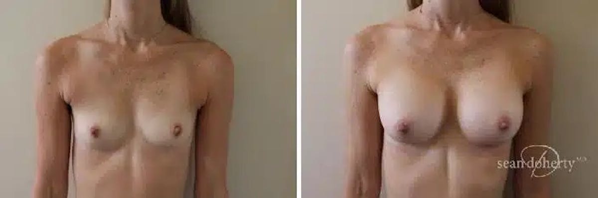 Breast Augmentation  Before & After Gallery - Patient 392805 - Image 1