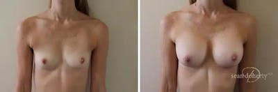 Breast Augmentation Before & After Gallery - Patient 392805 - Image 1