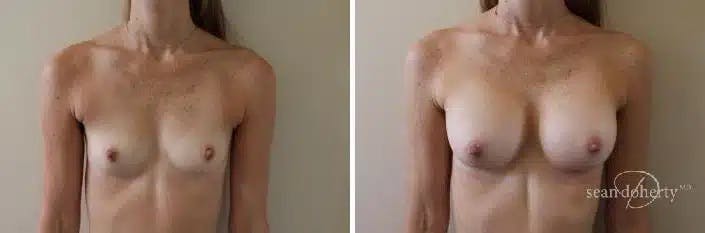 Breast Augmentation Before & After Gallery - Patient 392805 - Image 1