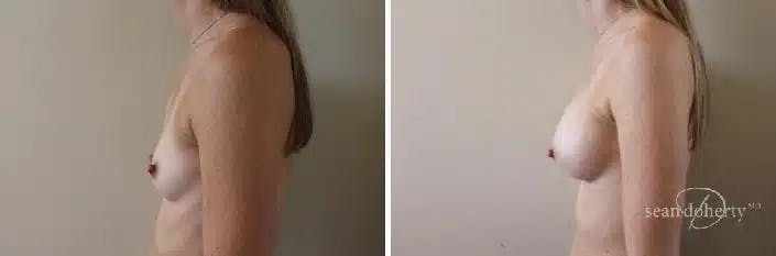 Breast Augmentation Before & After Gallery - Patient 392805 - Image 5