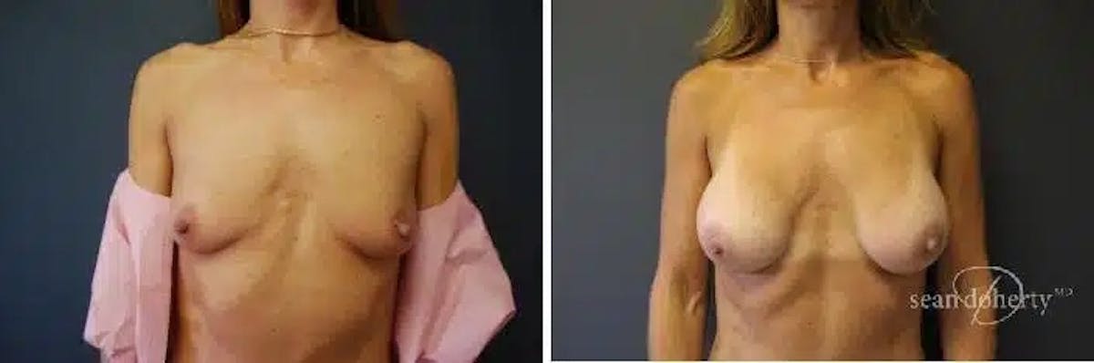 Breast Augmentation Before & After Gallery - Patient 135167 - Image 1