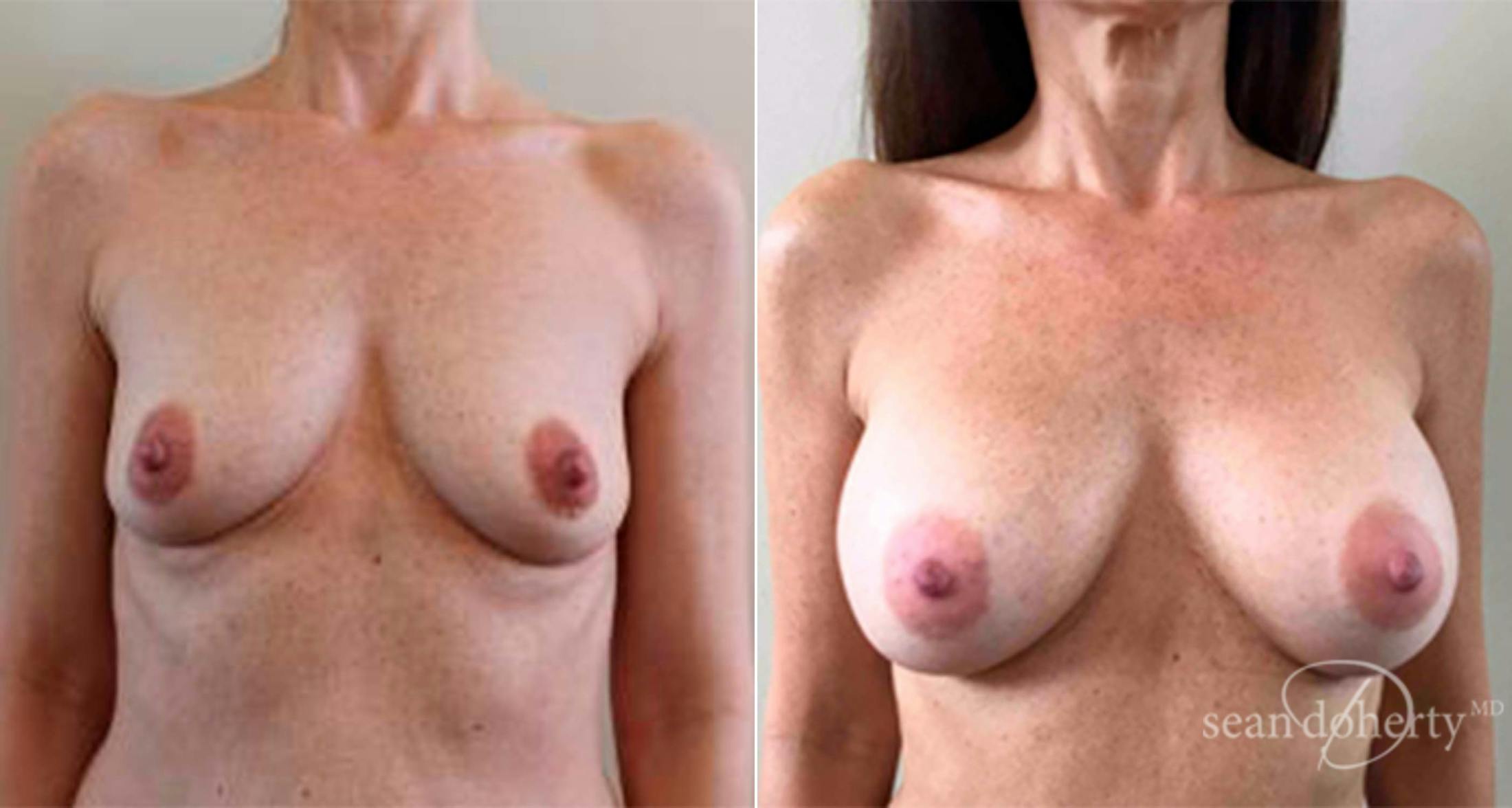 Breast Augmentation Before & After Gallery - Patient 299576 - Image 1
