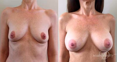 Breast Augmentation Before & After Gallery - Patient 299576 - Image 1