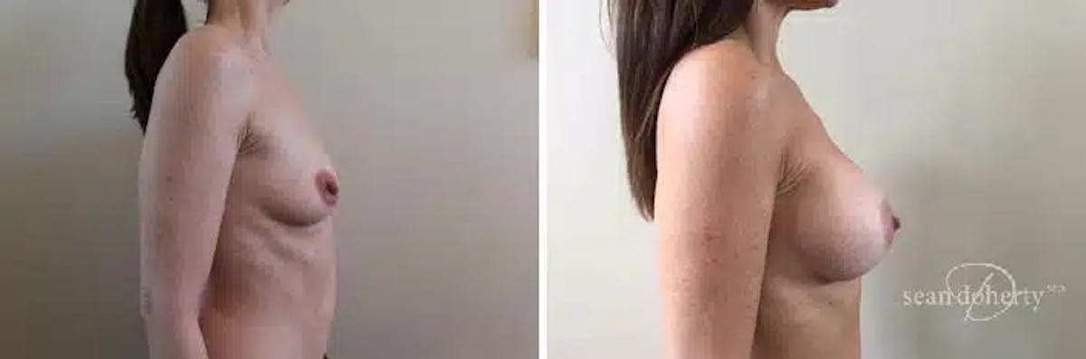 Breast Augmentation Before & After Gallery - Patient 299576 - Image 3