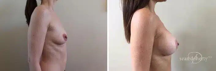 Breast Augmentation Before & After Gallery - Patient 299576 - Image 3