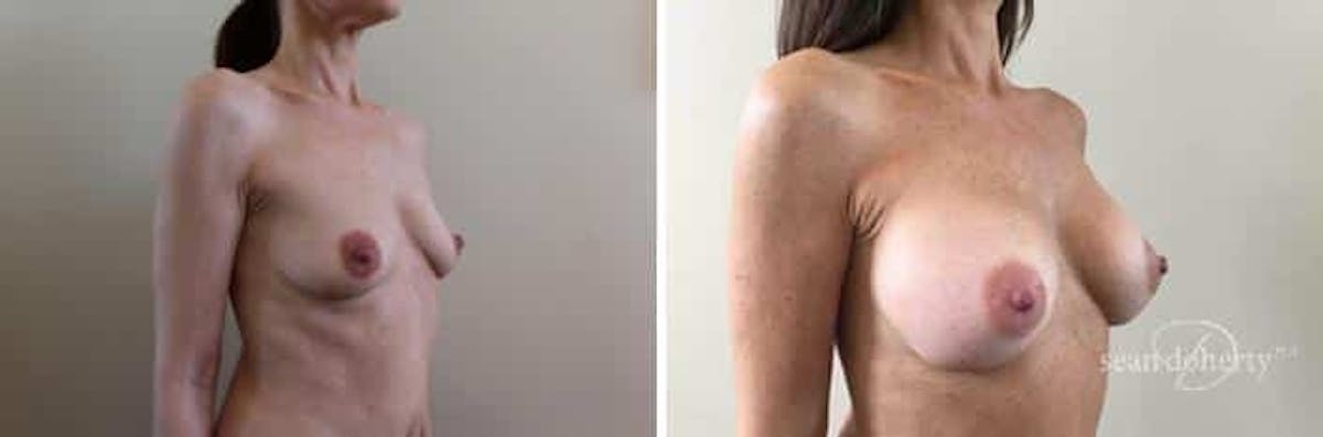 Breast Augmentation Before & After Gallery - Patient 299576 - Image 2