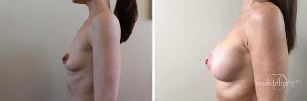Breast Augmentation Before & After Gallery - Patient 299576 - Image 5