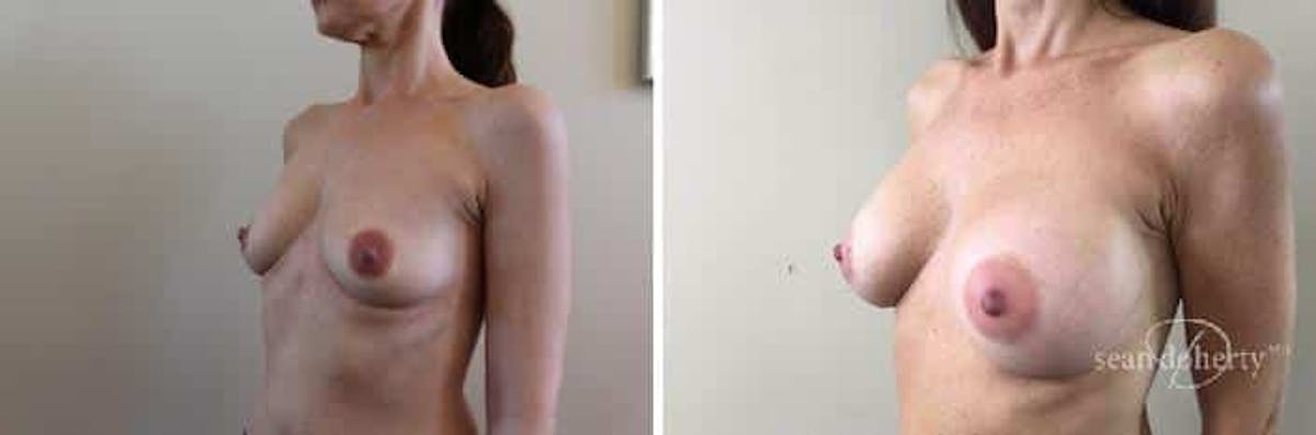 Breast Augmentation Before & After Gallery - Patient 299576 - Image 4