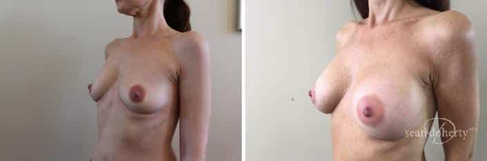 Breast Augmentation Before & After Gallery - Patient 299576 - Image 4