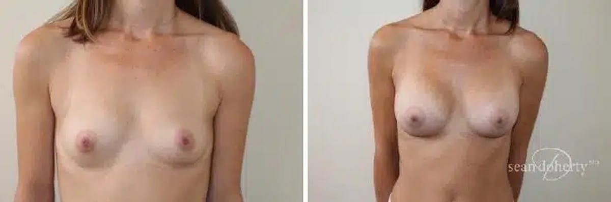 Breast Augmentation Before & After Gallery - Patient 303762 - Image 1