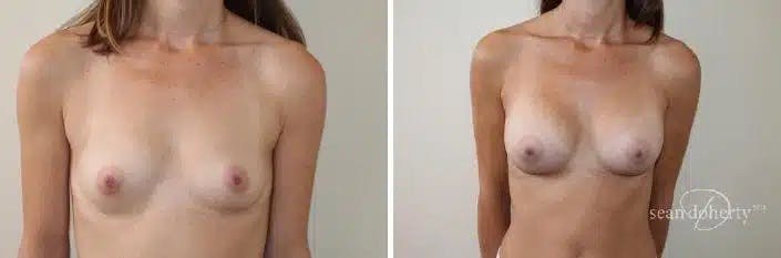 Breast Augmentation Before & After Gallery - Patient 303762 - Image 1