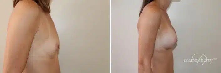Breast Augmentation Before & After Gallery - Patient 303762 - Image 2