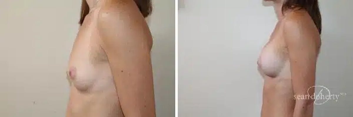 Breast Augmentation Before & After Gallery - Patient 303762 - Image 3