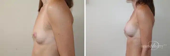 Breast Augmentation Before & After Gallery - Patient 303762 - Image 3