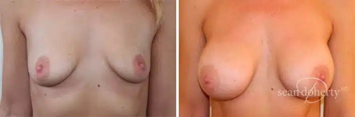 Breast Augmentation  Before & After Gallery - Patient 162221 - Image 1
