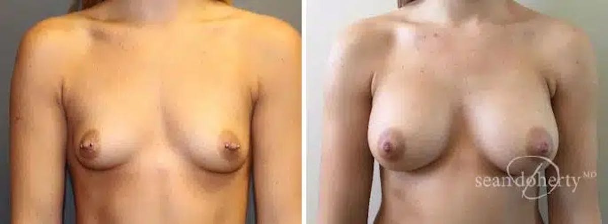 Breast Augmentation Before & After Gallery - Patient 283470 - Image 1