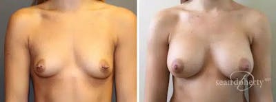Breast Augmentation Before & After Gallery - Patient 283470 - Image 1