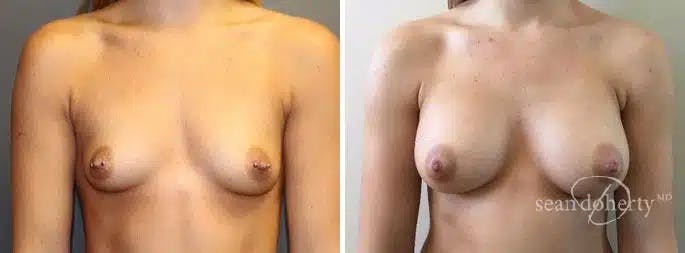 Breast Augmentation Before & After Gallery - Patient 283470 - Image 1