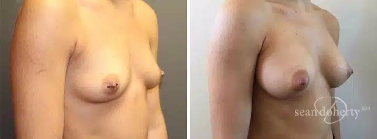 Breast Augmentation Before & After Gallery - Patient 283470 - Image 2