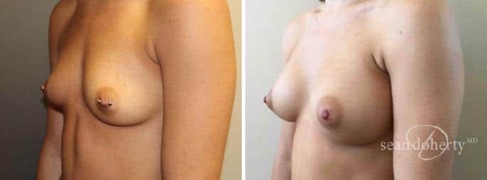 Breast Augmentation Before & After Gallery - Patient 283470 - Image 3