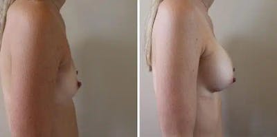 Breast Augmentation Before & After Gallery - Patient 403309 - Image 1