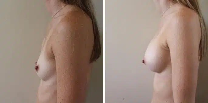 Breast Augmentation Before & After Gallery - Patient 403309 - Image 2