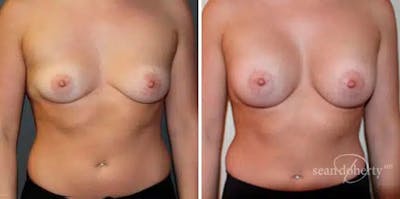 Breast Augmentation Before & After Gallery - Patient 463126 - Image 1