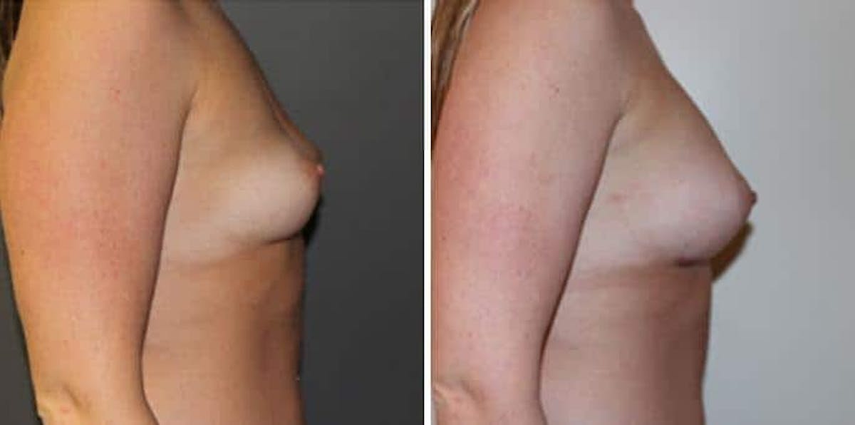 Breast Augmentation  Before & After Gallery - Patient 463126 - Image 2
