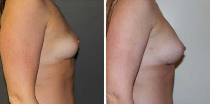 Breast Augmentation Before & After Gallery - Patient 463126 - Image 2