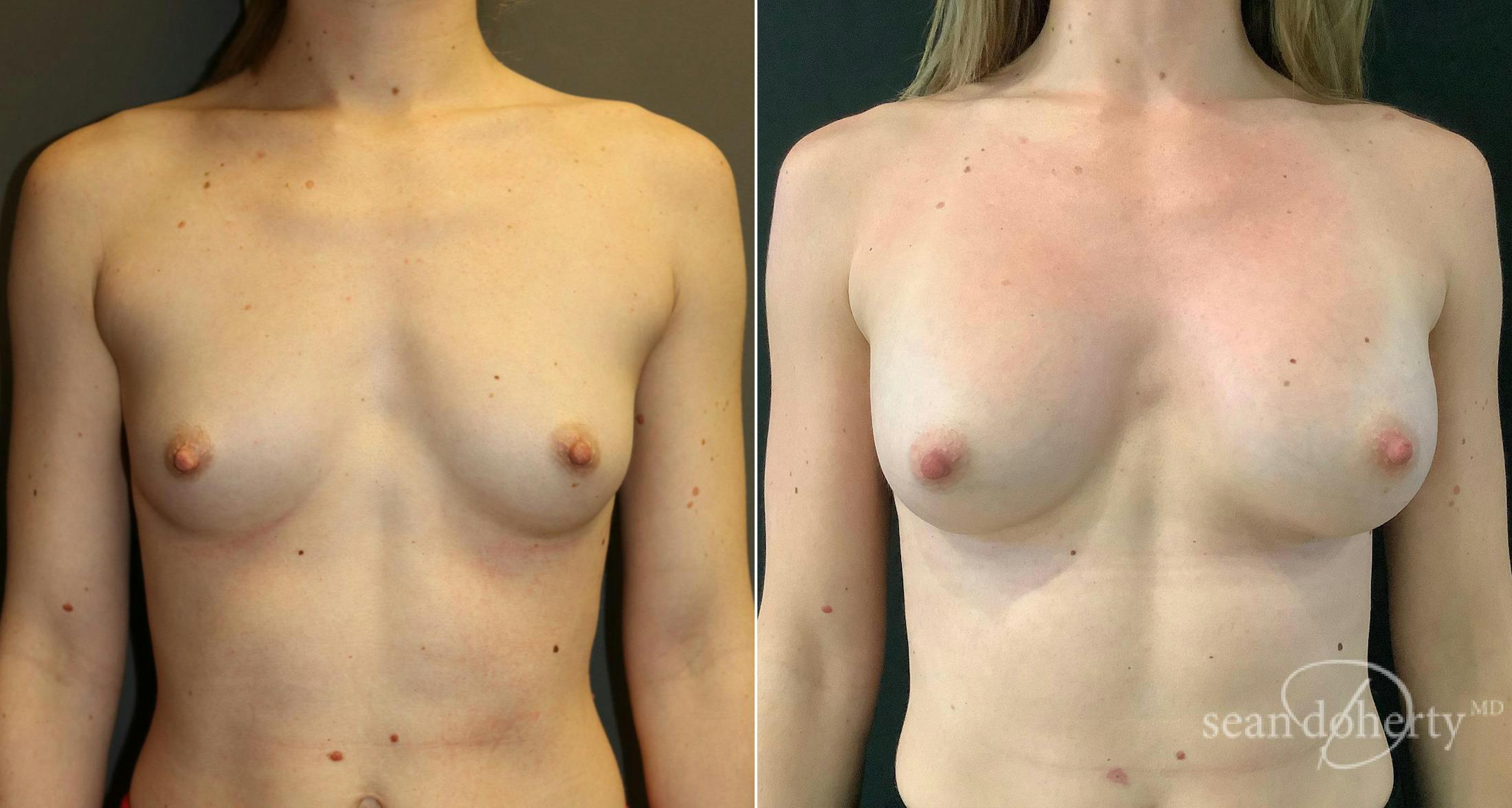 Breast Augmentation Before & After Gallery - Patient 134218 - Image 1