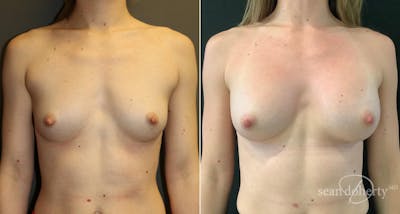 Breast Augmentation Before & After Gallery - Patient 134218 - Image 1