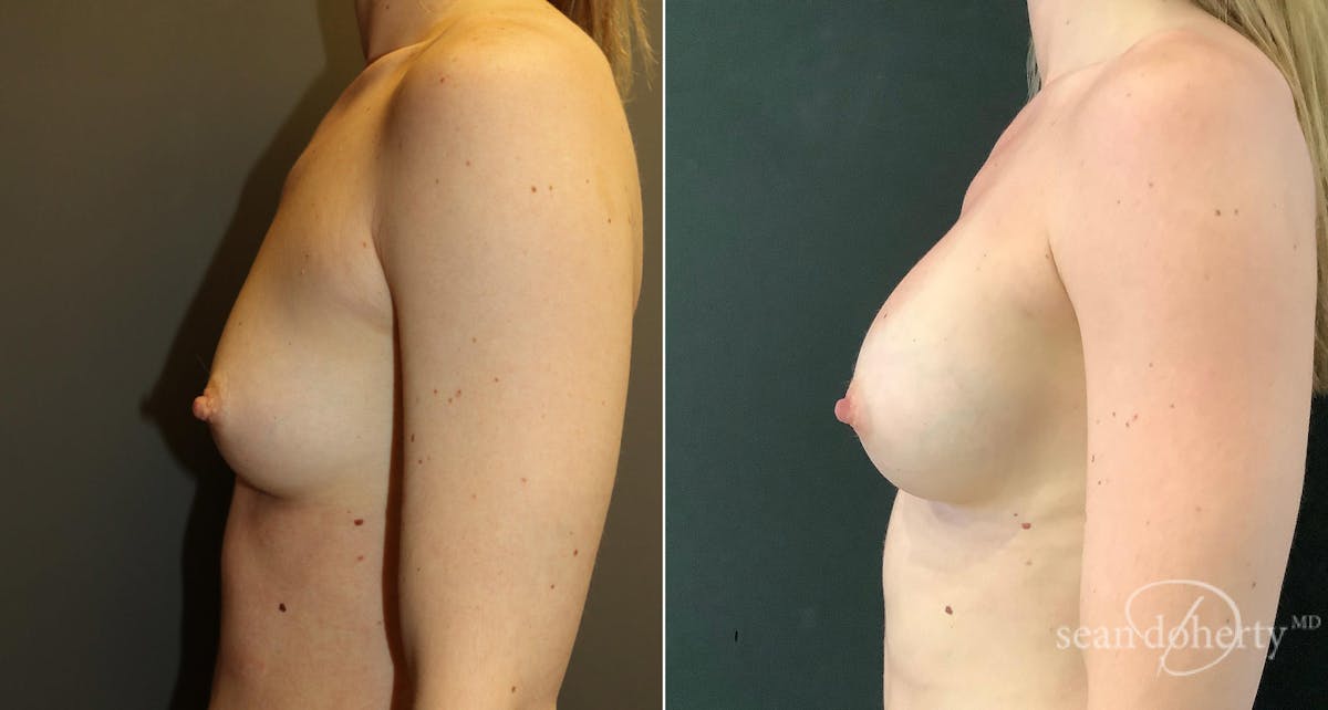 Breast Augmentation  Before & After Gallery - Patient 134218 - Image 3