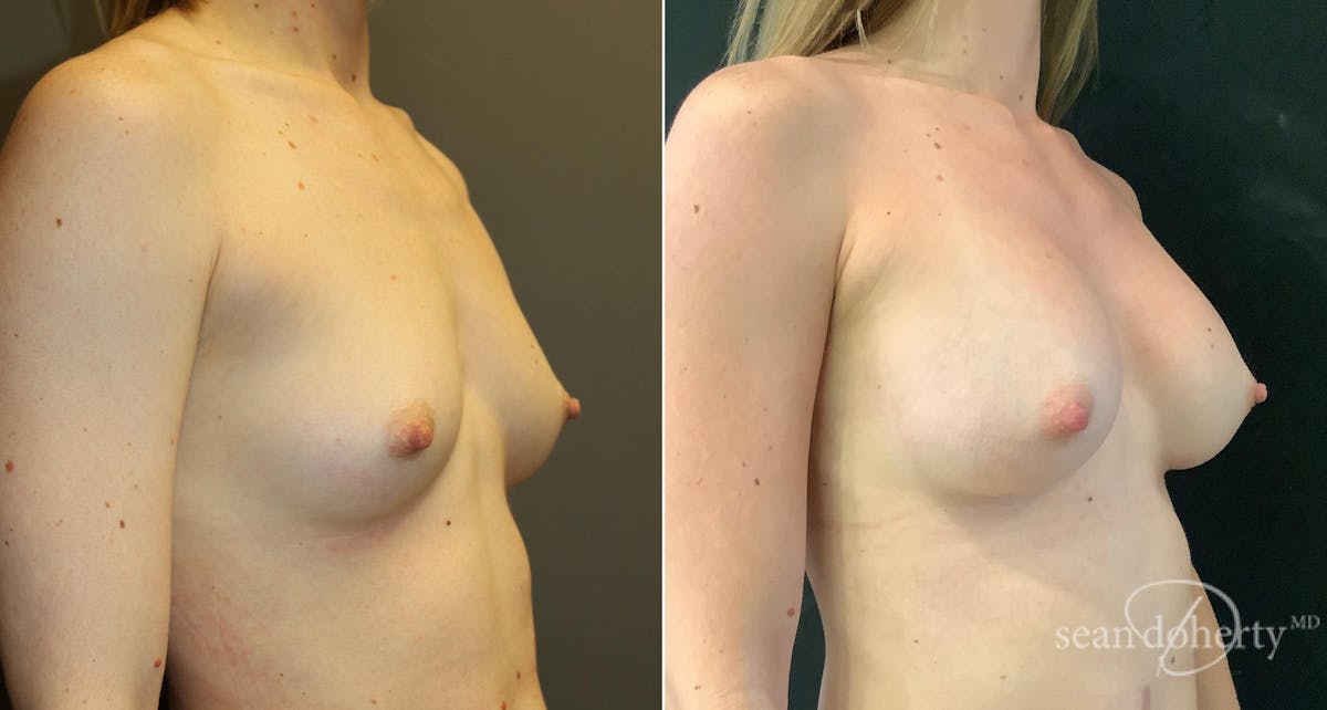 Breast Augmentation  Before & After Gallery - Patient 134218 - Image 2