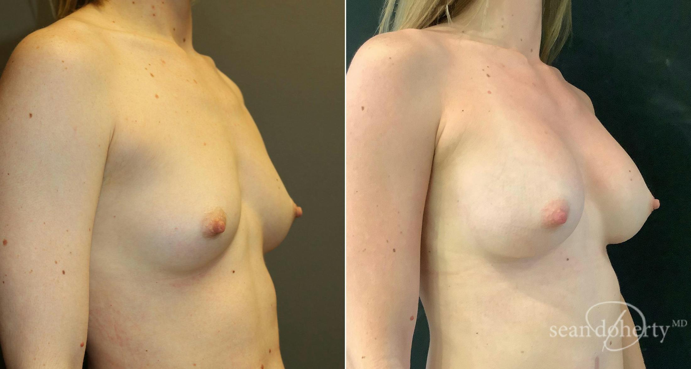 Breast Augmentation Before & After Gallery - Patient 134218 - Image 2