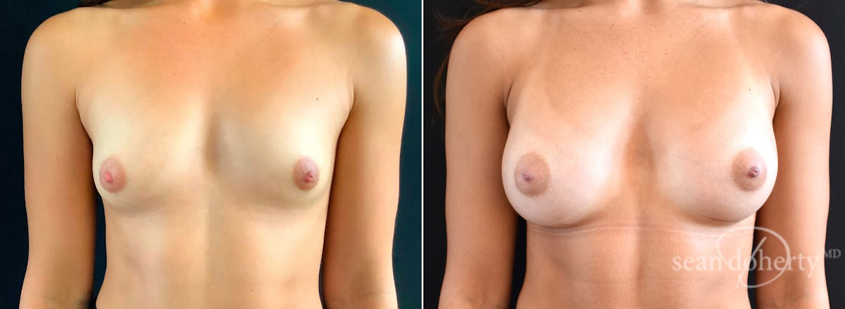 Breast Augmentation  Before & After Gallery - Patient 426497 - Image 1