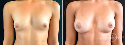 Breast Augmentation Before & After Gallery - Patient 426497 - Image 1