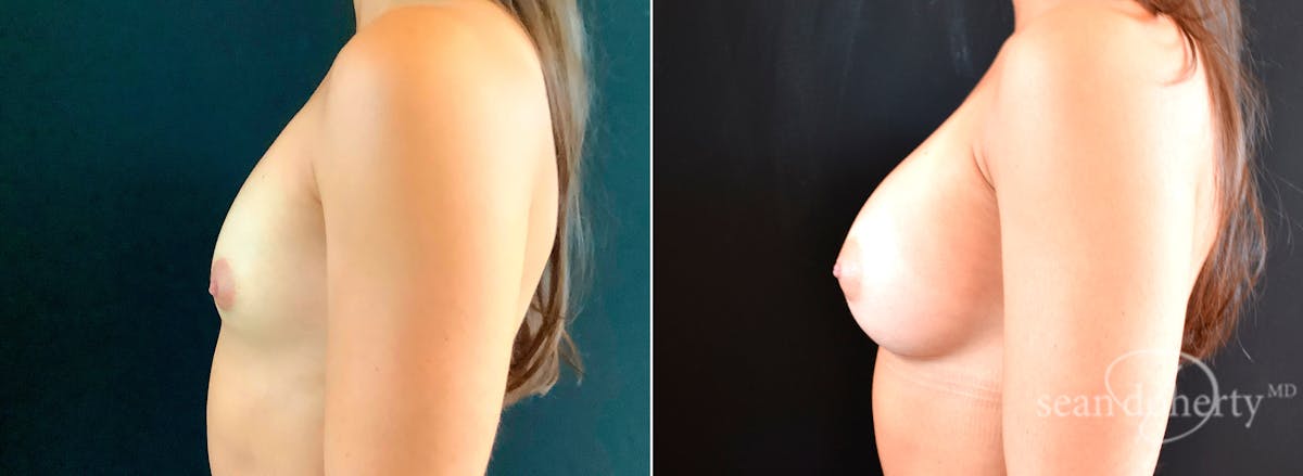 Breast Augmentation  Before & After Gallery - Patient 426497 - Image 3