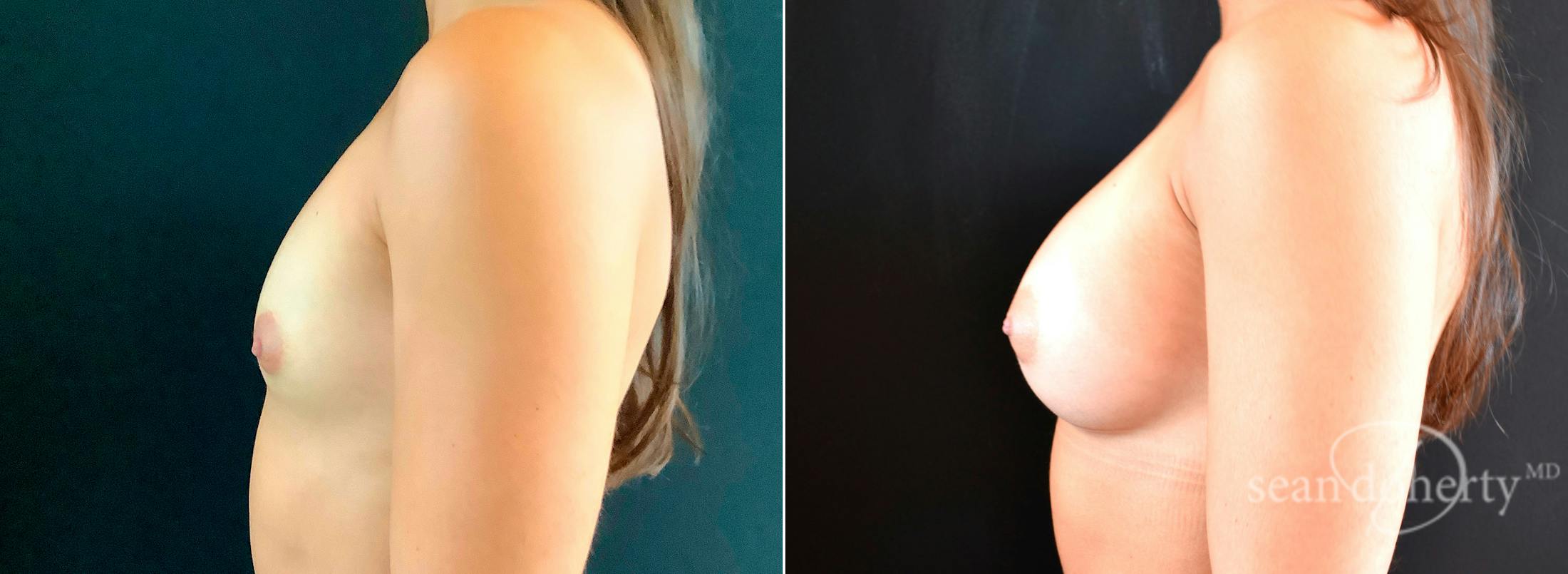 Breast Augmentation Before & After Gallery - Patient 426497 - Image 3