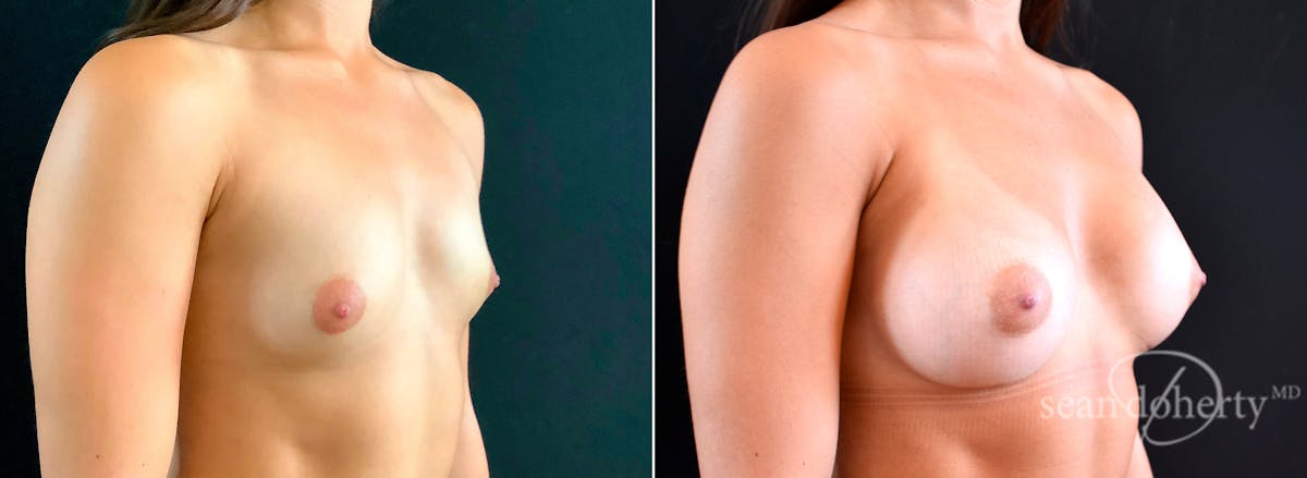 Breast Augmentation  Before & After Gallery - Patient 426497 - Image 2