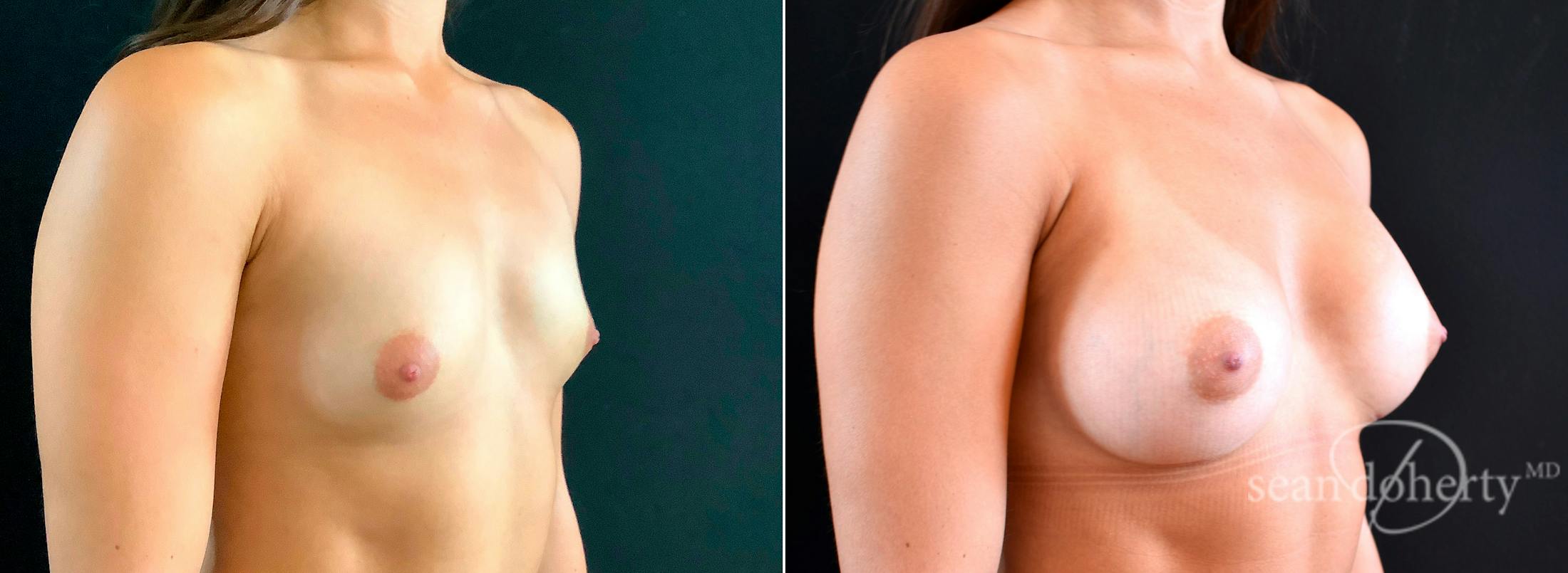 Breast Augmentation Before & After Gallery - Patient 426497 - Image 2