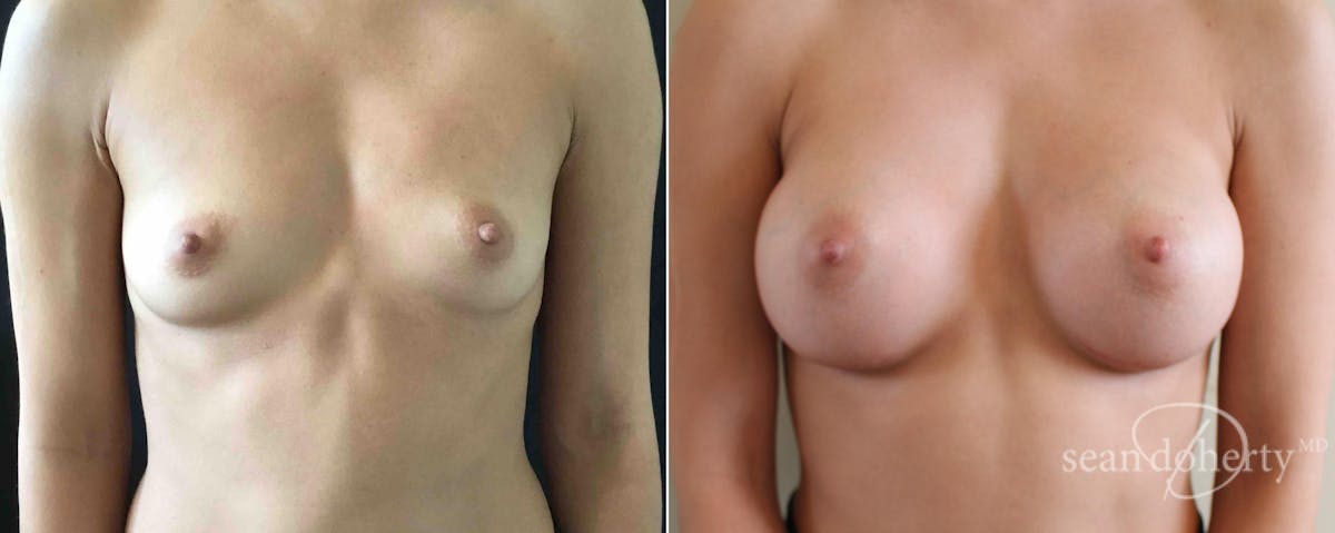 Breast Augmentation  Before & After Gallery - Patient 340444 - Image 1