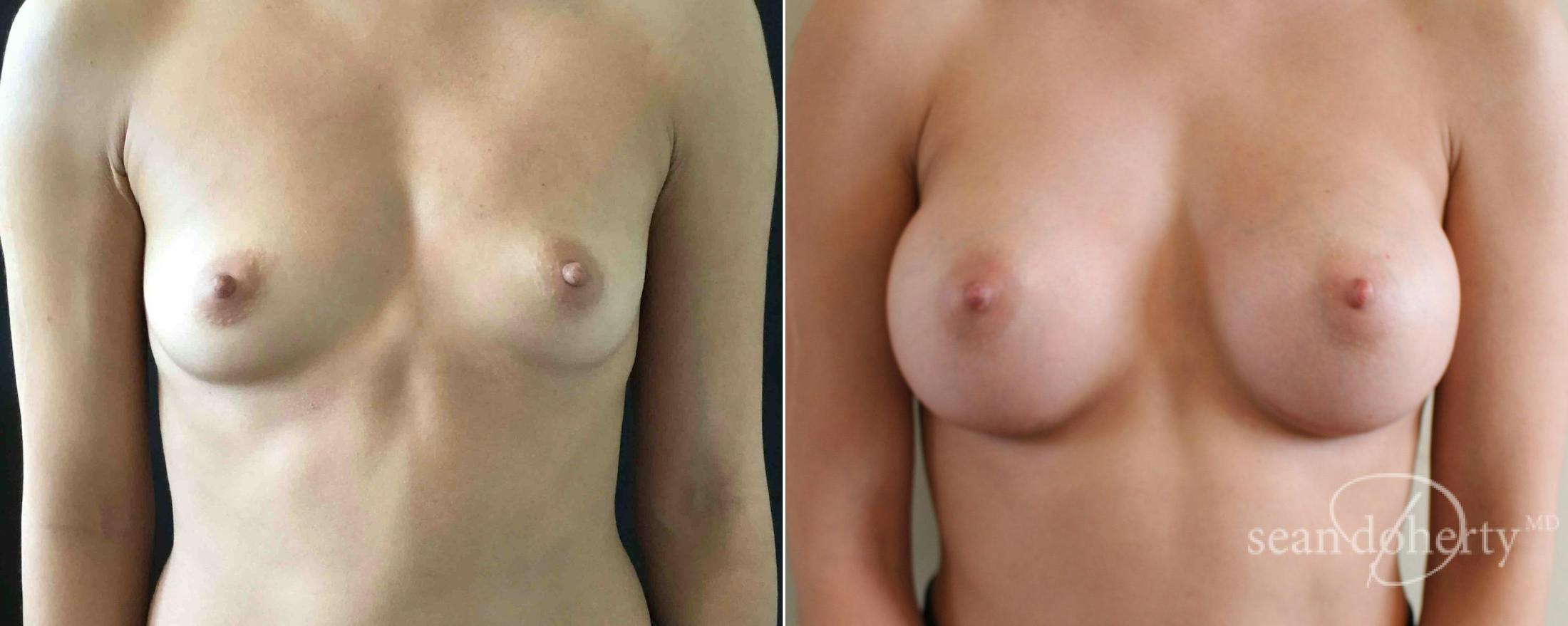 Breast Augmentation Before & After Gallery - Patient 340444 - Image 1