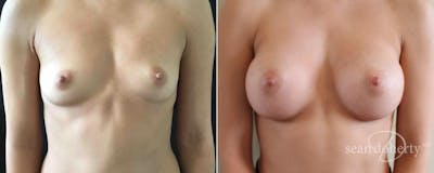 Breast Augmentation Before & After Gallery - Patient 340444 - Image 1