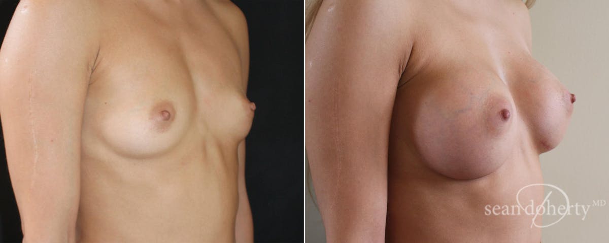Breast Augmentation  Before & After Gallery - Patient 340444 - Image 2