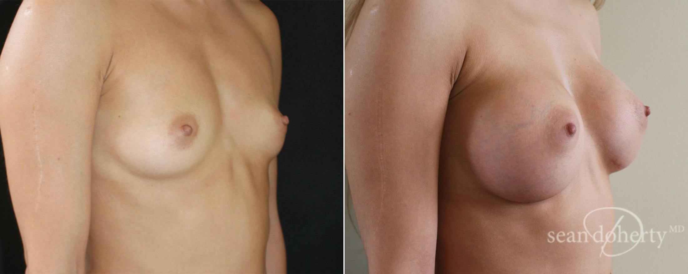 Breast Augmentation Before & After Gallery - Patient 340444 - Image 2