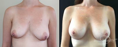 Breast Augmentation Before & After Gallery - Patient 112266 - Image 1